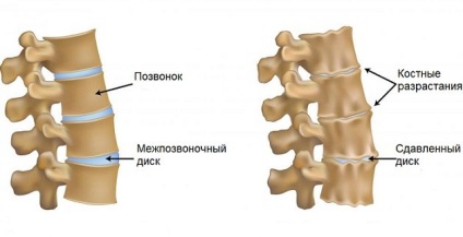 Sindromul spondilartrozei cervicale uncovertebrale, cum se trateaza