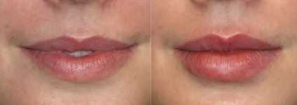 Creșterea buzelor (chirurgicale)