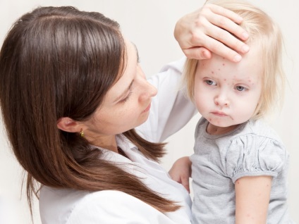 Bárányhimlő a baba tüneteiben és kezelésében