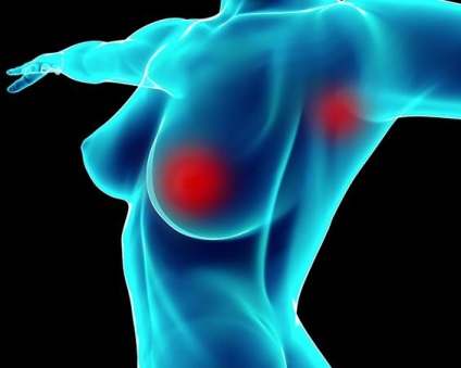 Tipuri de cancer mamar la femei, ce specii sunt