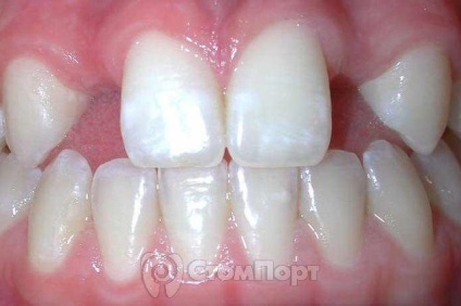Se explică cauzele apariției dinților supercompletați