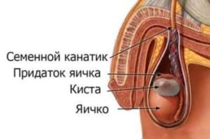 Gyermekgyógyászati ​​testis férfiaknál epididim cisztákkal és a herékben