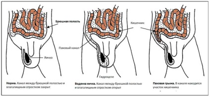 Testele pediatrice la bărbații tratați cu chisturi de epididim și sigiliile în testicule