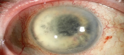 Inflamația corpului vitros al ochiului (endoftalmită) - ceea ce este periculos, cauzele, simptomele și metodele de tratament