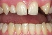 Az egyszemélyes dentition defektusok helyreállítása megerősített tapadóhidakkal