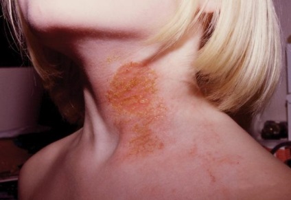 Boala eczemei ​​la adolescenți cauzează, simptome, tratament