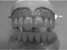 Proteze dentare pe baza de materiale plastice acrilic bemzonomerice - fabricarea protezelor din
