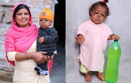 21 de ani indian arată ca un copil de șase luni