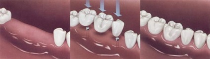 És mit tudsz az implantátumokról (vagy egy kicsit a mesterséges gyökerekről)