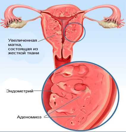 Adenomioza de gradul 2 - ce este tratamentul, simptomele?