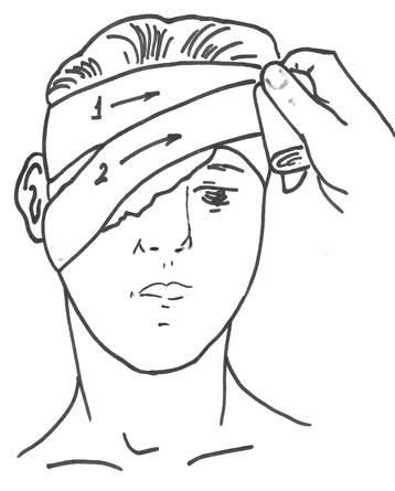Algoritmul aplicării unui bandaj la un singur ochi (monocular)