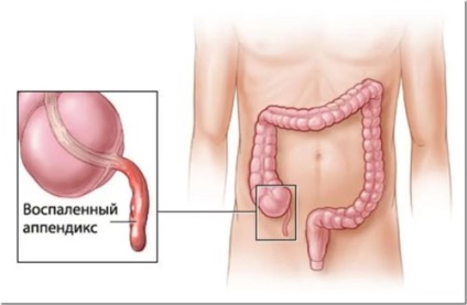 Apendicita din cauza semințelor poate fi, mit sau realitate