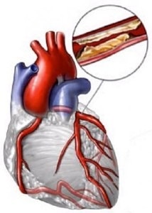 Ateroscleroza aortei inimii - ceea ce este, simptomele și tratamentul