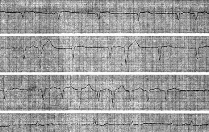 Disocierea atrioventriculară - aritmii combinate - electrocardiografie practică -