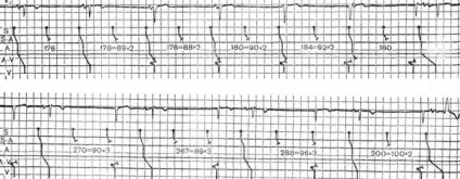 Disocierea atrioventriculară - aritmii combinate - electrocardiografie practică -