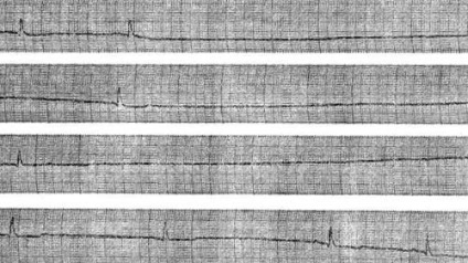 Disocierea atrioventriculară - aritmii combinate - electrocardiografie practică -