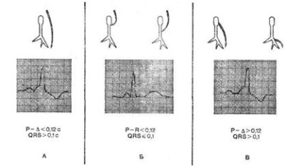 Disocierea atrioventriculară - aritmii combinate - electrocardiografie practică -