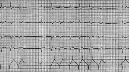 Disocierea atrioventriculară - aritmii combinate - electrocardiografie practică -