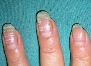 Pete albe pe unghiile degetelor - motivul pentru care înseamnă