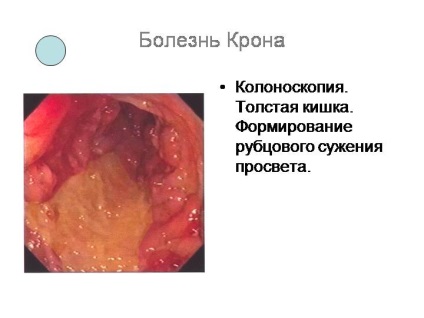 Simptomele bolii Crohn, tratamentul, diagnosticul bolii Crohn a colonului și a intestinului subțire