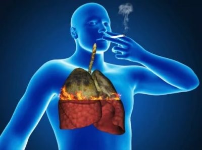 Bronșita fumător la adulți cu simptome și tratament, medicamente, remedii populare