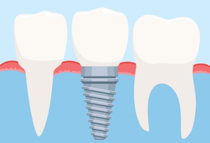 Ce este mai bine să alegi implantarea sau proteza dinților