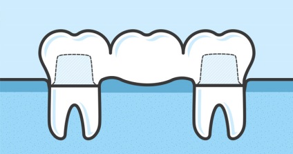Ce este mai bine să alegi implantarea sau proteza dinților