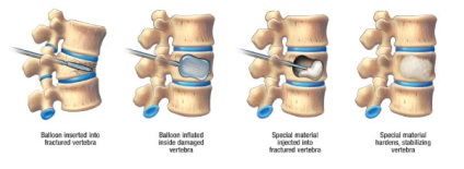 Ce sunt fracturile spinale, mediile de viață ale sănătății