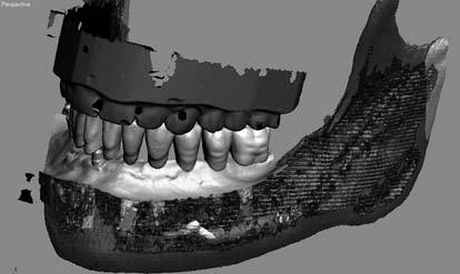 Implantarea dentară utilizând un șablon de implantologie de navigație