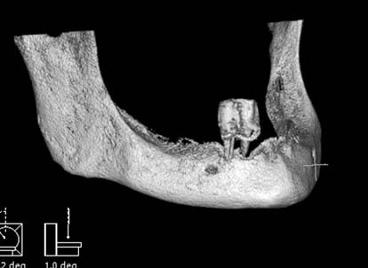 Implantarea dentară utilizând un șablon de implantologie de navigație