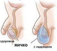 Diafanoscopia scrotului și a testiculelor