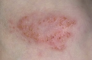 Eczema este contagioasă sau nu - o caracteristică a problemei