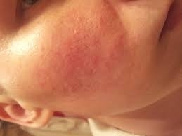 Eczema este contagioasă sau nu - o caracteristică a problemei