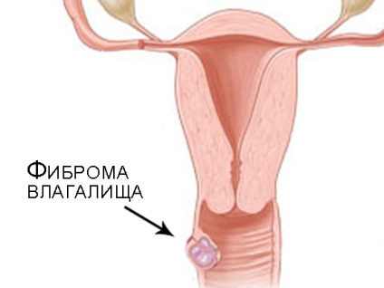 Hüvelyi fibroma tünetei és kezelése