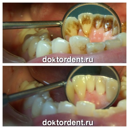 Igiena orală în stomatologie, care este inclusă în această procedură