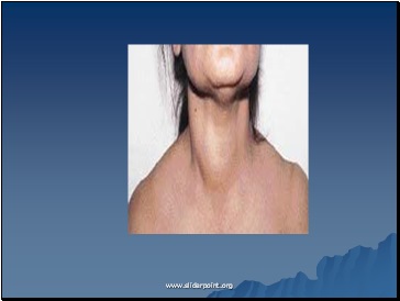 Hipertiroidismul tiroidian - medicină de prezentare