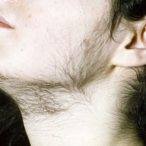 Hirsutism la tratamentul femeilor, cauze, hormoni, fotoepilarea ipl cu hirsutism