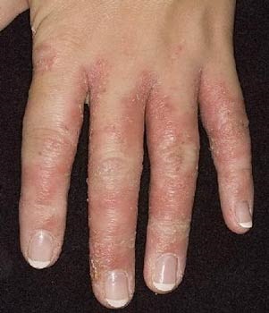 Kézgomba - Tünetek és Terápia