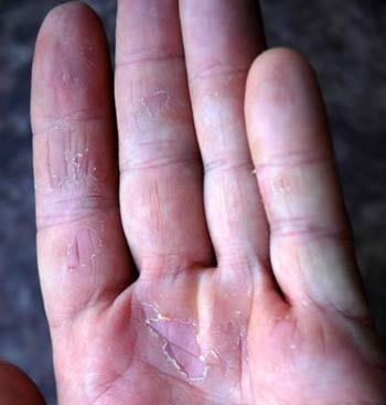 Mi Candida kézen - tünetek és kezelés