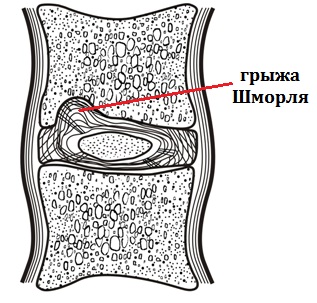 Herniata hernie