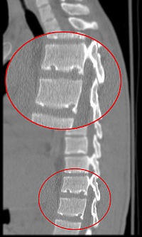 Hernia shmorlya, centrul pula