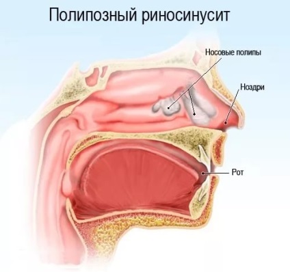 Cum se vindecă rinosinusita cronică de polipoză