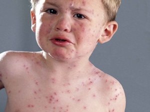 Rubella tünetei és kezelése felnőtteknél és gyermekeknél