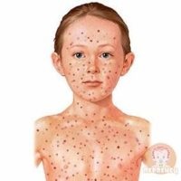 A rubeola gyermekeknél - tünetek, szakaszok és kezelés