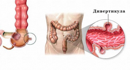 Tratamentul diverticulozei cu remedii folclorice