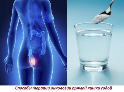 Tratamentul cancerului rectal cu sifon, clismă, de către neumyvakinu