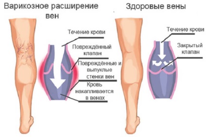 Tratamentul venelor varicoase cu remedii folclorice