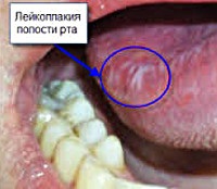 Leukoplakia - okai, tünetei, diagnózisa és kezelése