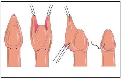 Circumcizia la băieți de ce o face și cum să aibă grijă după operație