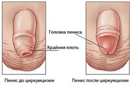 Обрязани момчета какво правят и как да се грижат за операцията